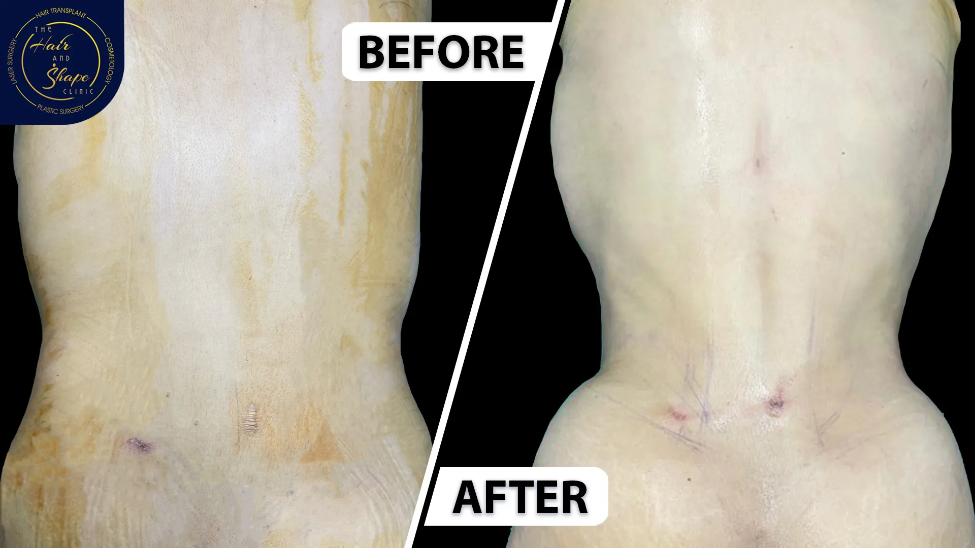 Back Liposuction result1